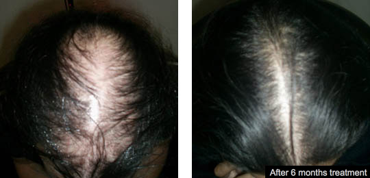 laser hair loss treatment